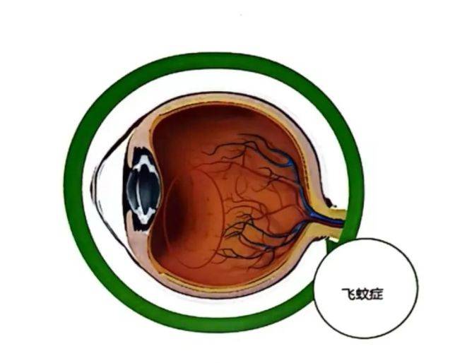 飛蚊癥治療最新突破，開啟視界新篇章